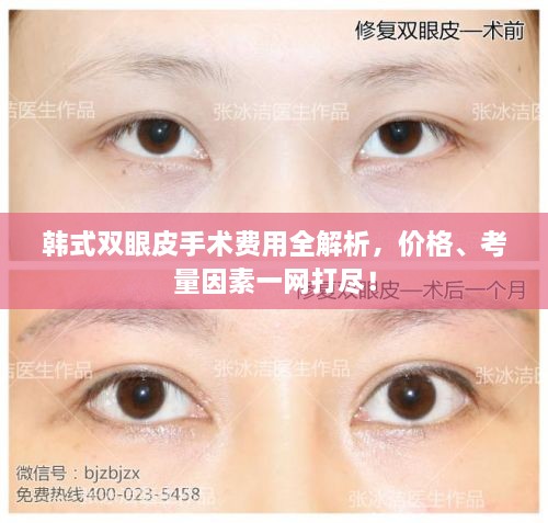 韓式雙眼皮手術(shù)費(fèi)用全解析，價(jià)格、考量因素一網(wǎng)打盡！