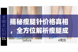 揭秘瘦腿針價格真相，全方位解析瘦腿成本！