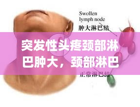 突發(fā)性頭疼頸部淋巴腫大，頸部淋巴結疼頭疼 