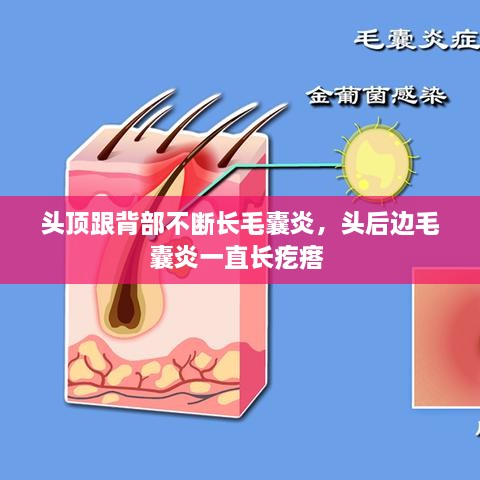 頭頂跟背部不斷長(zhǎng)毛囊炎，頭后邊毛囊炎一直長(zhǎng)疙瘩 