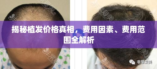 揭秘植發(fā)價格真相，費用因素、費用范圍全解析