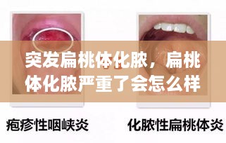 突發(fā)扁桃體化膿，扁桃體化膿嚴重了會怎么樣了 