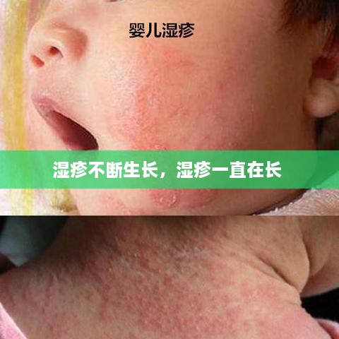 濕疹不斷生長(zhǎng)，濕疹一直在長(zhǎng) 